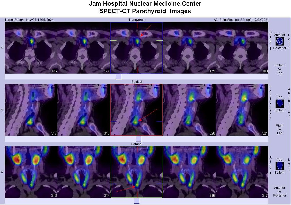 Parathyroid SPECT-CT