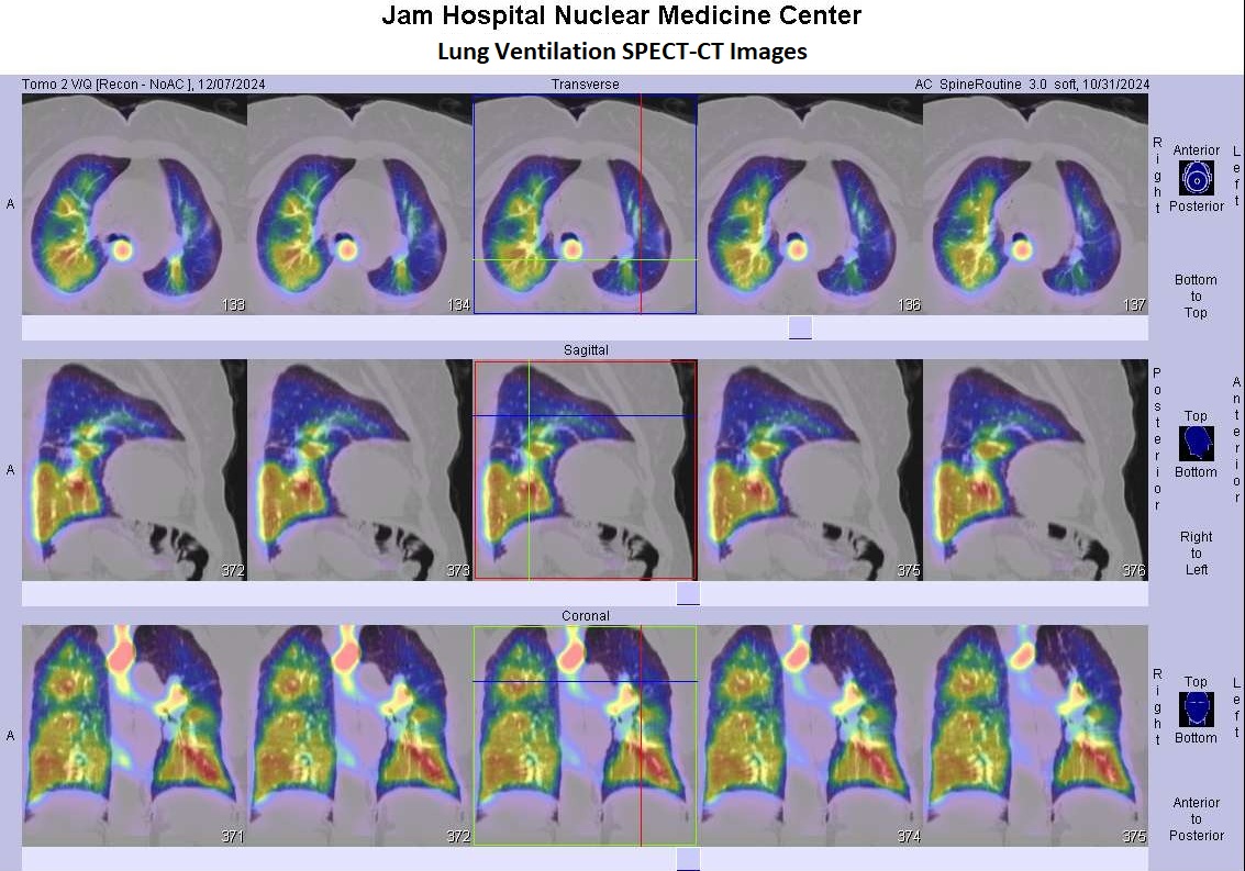 Lung Ventilation SPECT-CT